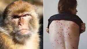 الصحة: ظهور اول اصابة بجدري القرود في السعودية