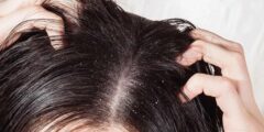 طريقة التخلص قشرة الشعر نهائيا مضمون