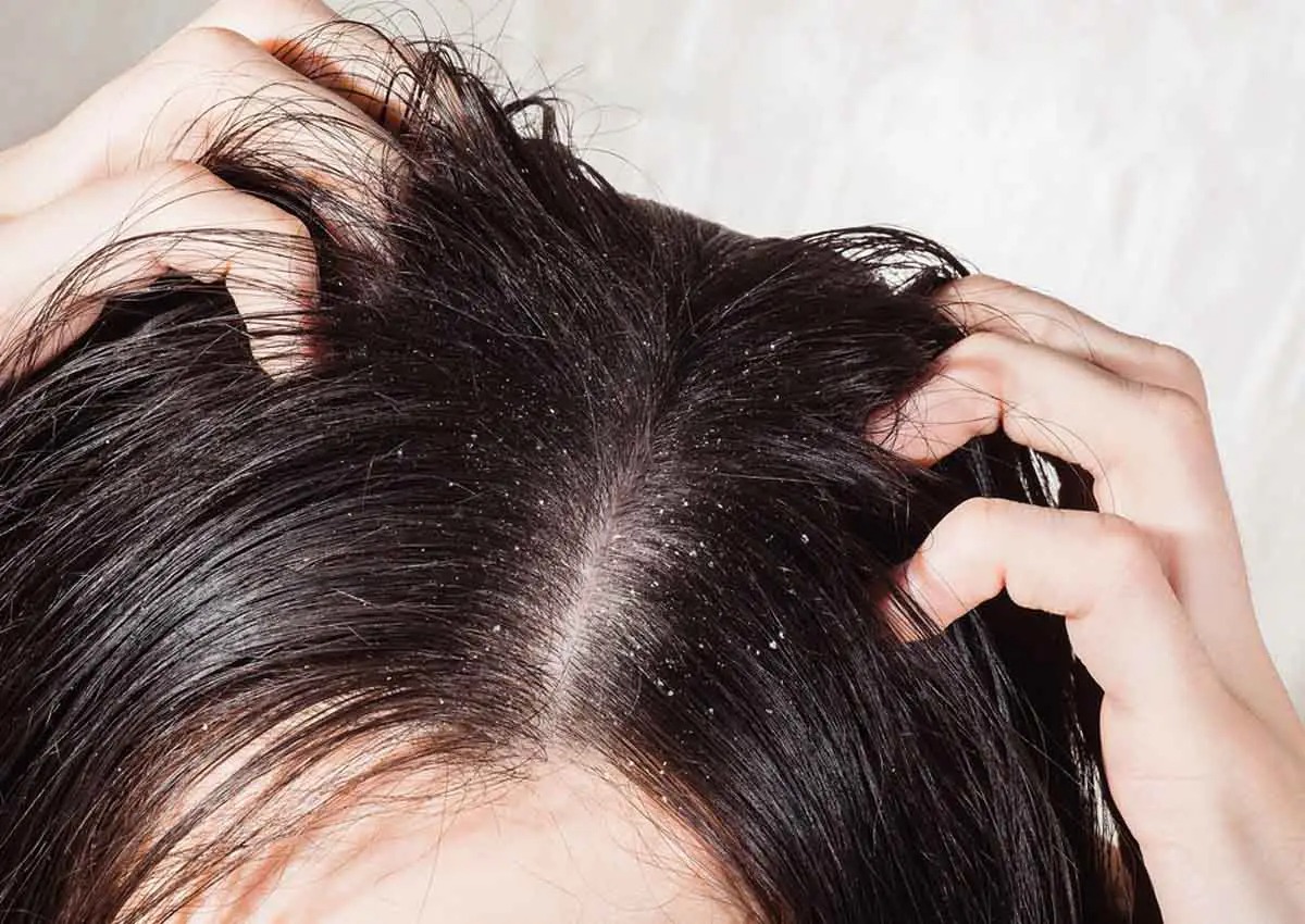 طريقة التخلص قشرة الشعر نهائيا مضمون